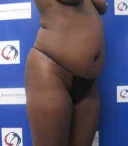 Before Image: Liposculpture and Fat Transfer to Buttocks