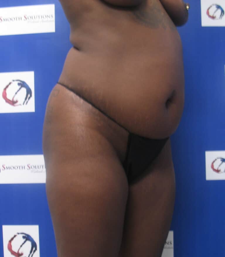 Before Image: Liposculpture and Fat Transfer to Buttocks - right-front-oblique