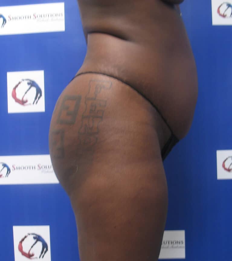 Before Image: Liposculpture and Fat Transfer to Buttocks - right-side