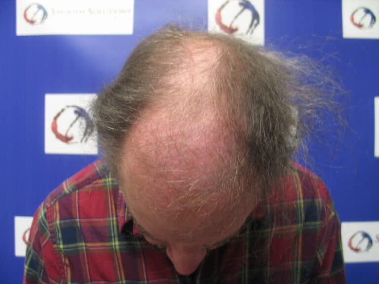 Before Image: Patient # 5191 - front