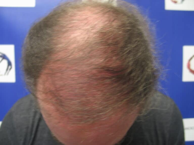 After Image: Patient # 5191 - front