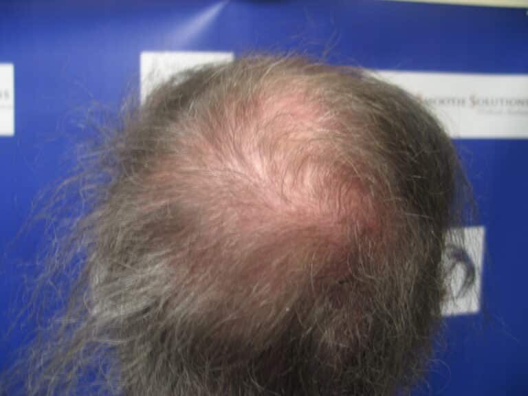 Before Image: Patient # 5191 - front