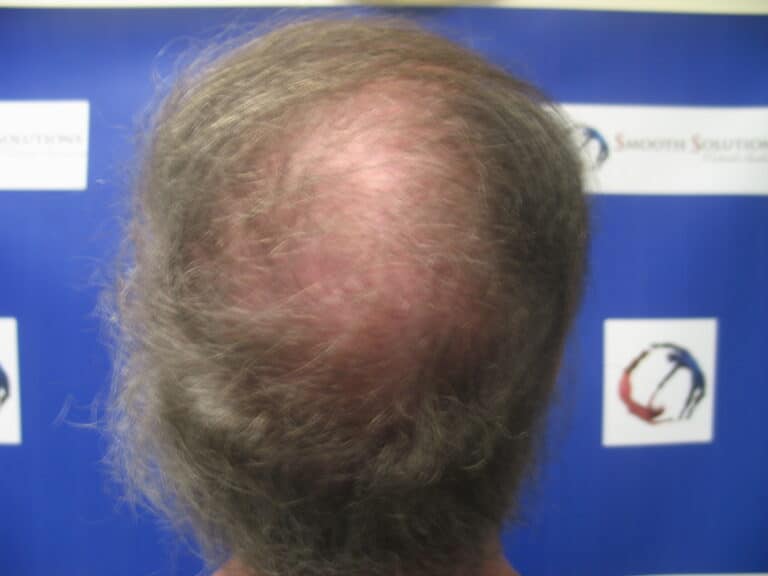 After Image: Patient # 5191 - front