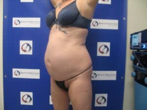 Before Image: Vaser Liposuction
