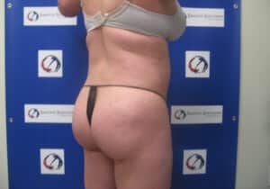 Before Image: Brazilian Butt Lift