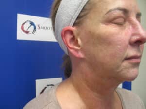 Before Image: Sylfirm and Hyperpigmentation