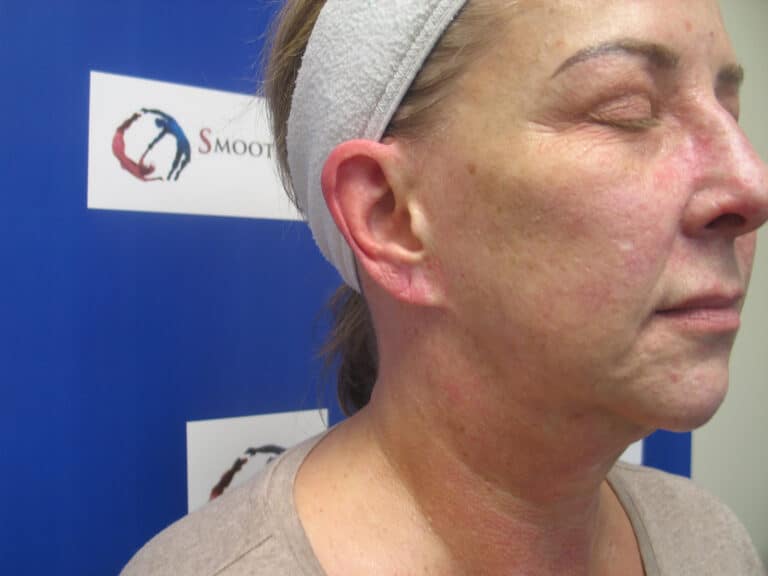 Before Image: Sylfirm and Hyperpigmentation - right-front-oblique