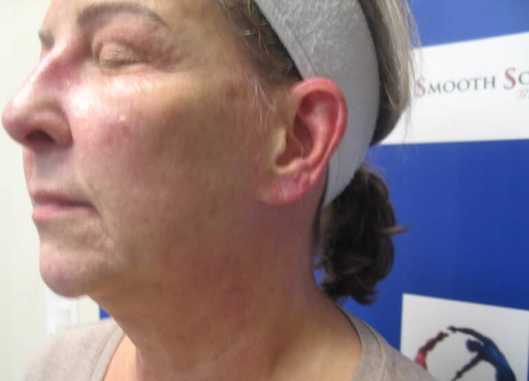 Before Image: Sylfirm and Hyperpigmentation - left-front-oblique