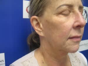 After Image: Sylfirm and Hyperpigmentation