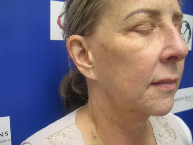 After Image: Sylfirm and Hyperpigmentation - right-front-oblique