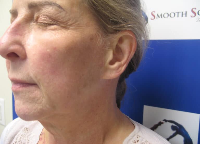 After Image: Sylfirm and Hyperpigmentation - left-front-oblique