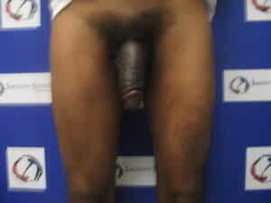 After Image: Penile Augmentation