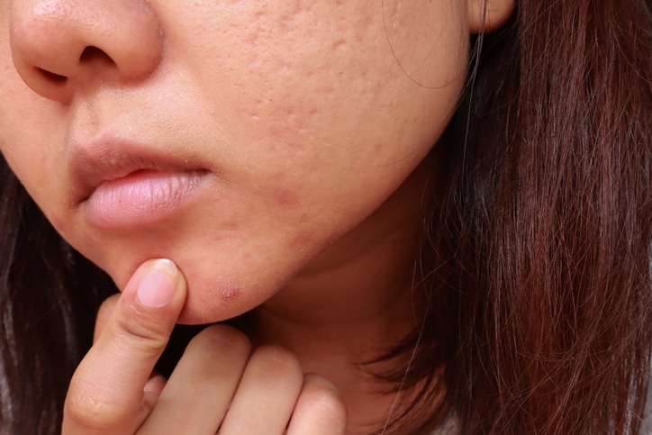 Splinter Like Acne Why Sylfirm Is a Top Choice for Acne Scars and Redness in Williamsville