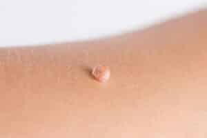 Image of a skin tag on a person's skin
