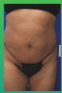 Before Image: Liposculpture