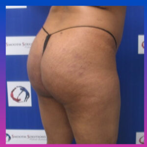 Before Image: Brazilian Butt Lift