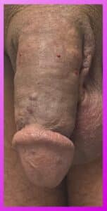 After Image: Penile Augmentation