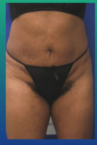 After Image: Liposculpture