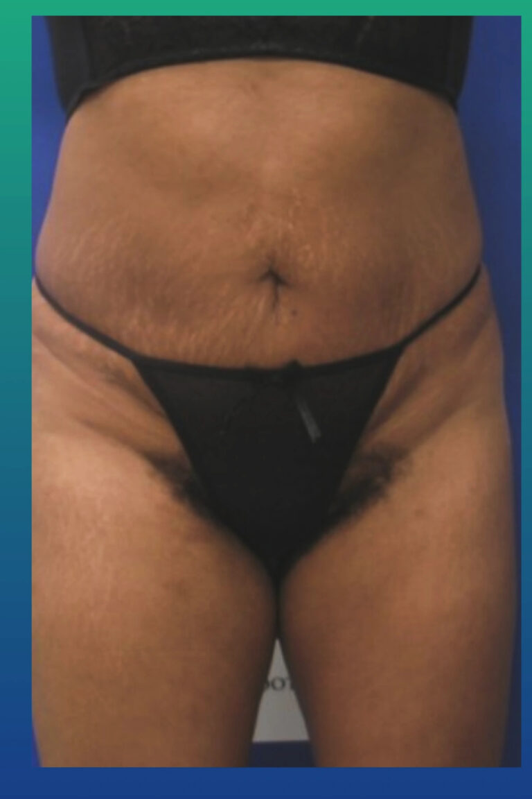 After Image: Liposculpture - front