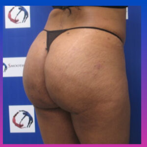 After Image: Brazilian Butt Lift