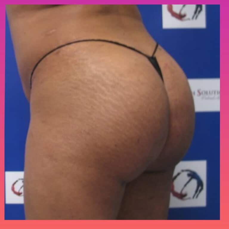 Before Image: Brazilian Butt Lift - left-back-oblique