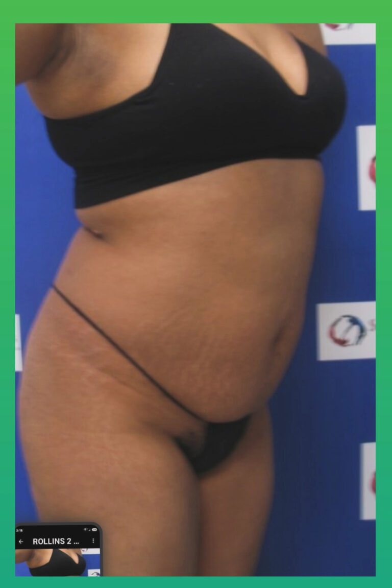 Before Image: Liposculpture - right-front-oblique