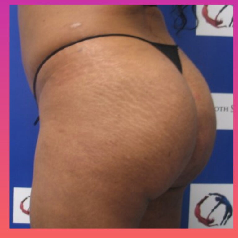 After Image: Brazilian Butt Lift - left-back-oblique