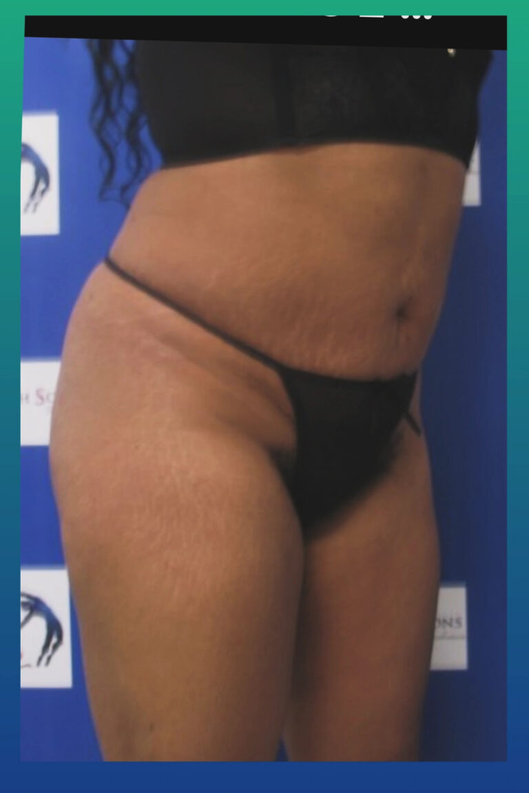 After Image: Liposculpture - right-front-oblique