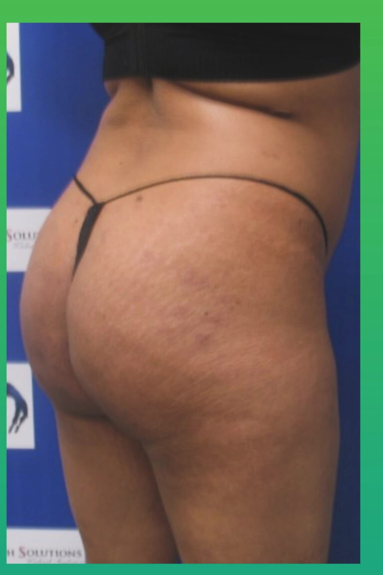 Before Image: Liposculpture - right-back-oblique