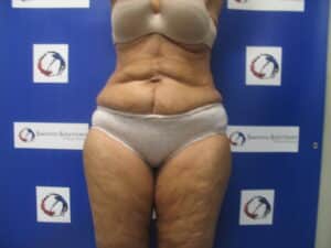 After Image: Liposculpture