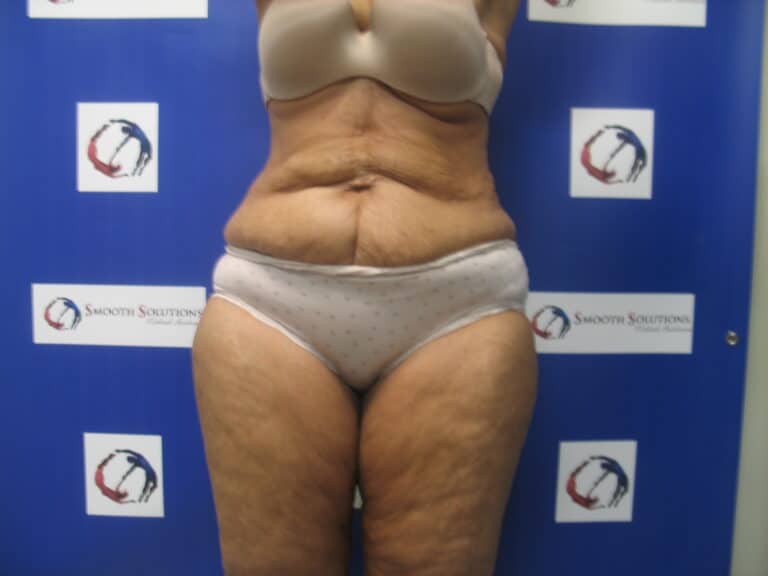 After Image: Liposculpture - front