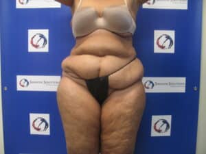 Before Image: Liposculpture