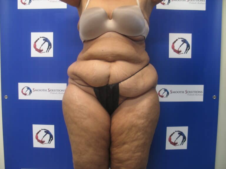 Before Image: Liposculpture - front