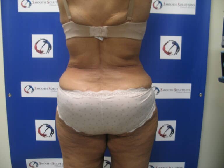 After Image: Liposculpture - back