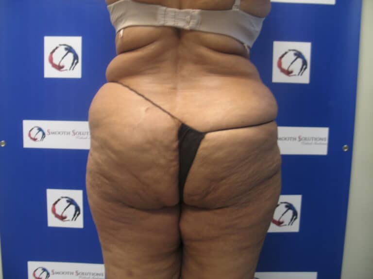 Before Image: Liposculpture - back