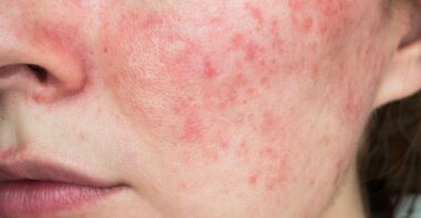 Papulopustular,Rosacea,,Close up,Of,The,Patient's,Cheek