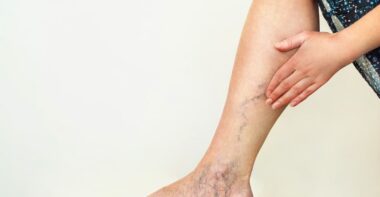 Varicose veins on the womans legs