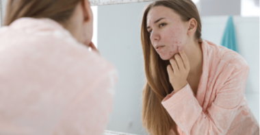 woman with acne problem near mirror in bathroom