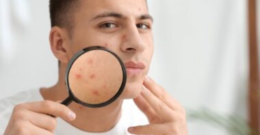 young man with acne problem and magnifier at home